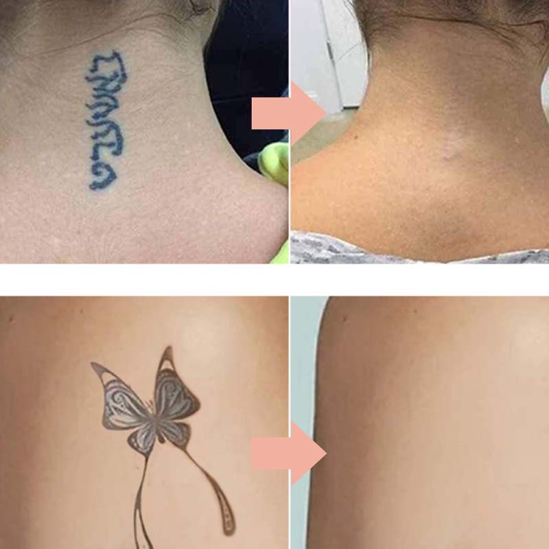 🔥 UP TO 50% OFF · Gentle Effective Multi-Use Tattoo Fading Cream ✨